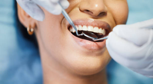 Best Emergency Wisdom Tooth Extraction in West Pelzer, SC